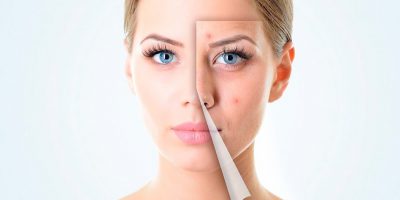 Piel grasa y con acné - Aceites para el cuidado de la piel